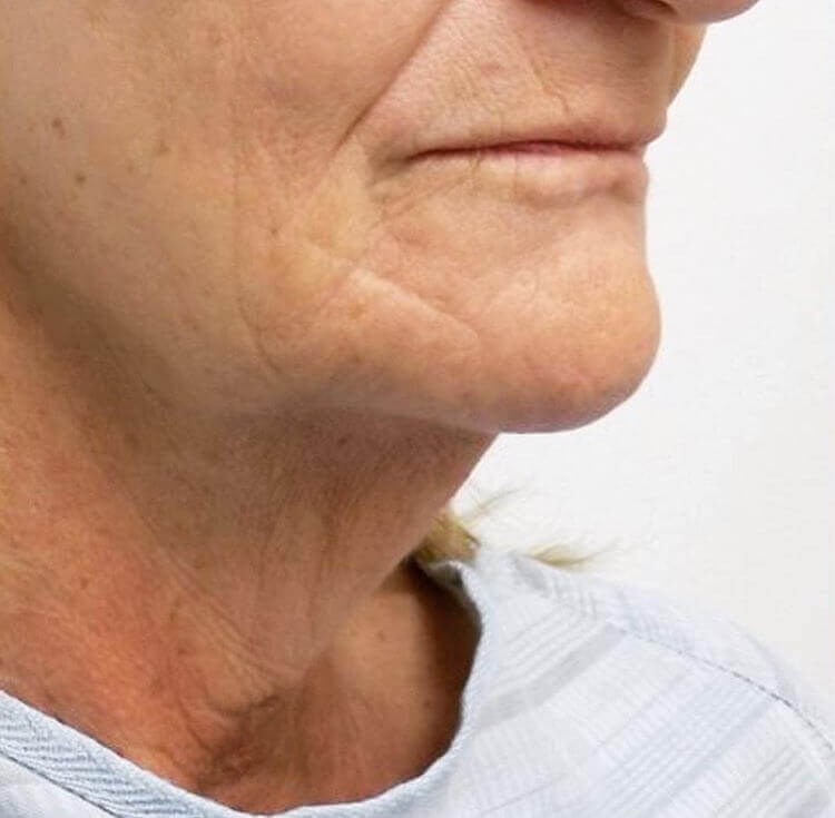 San Diego Facelift Before San Diego Facelift Before
