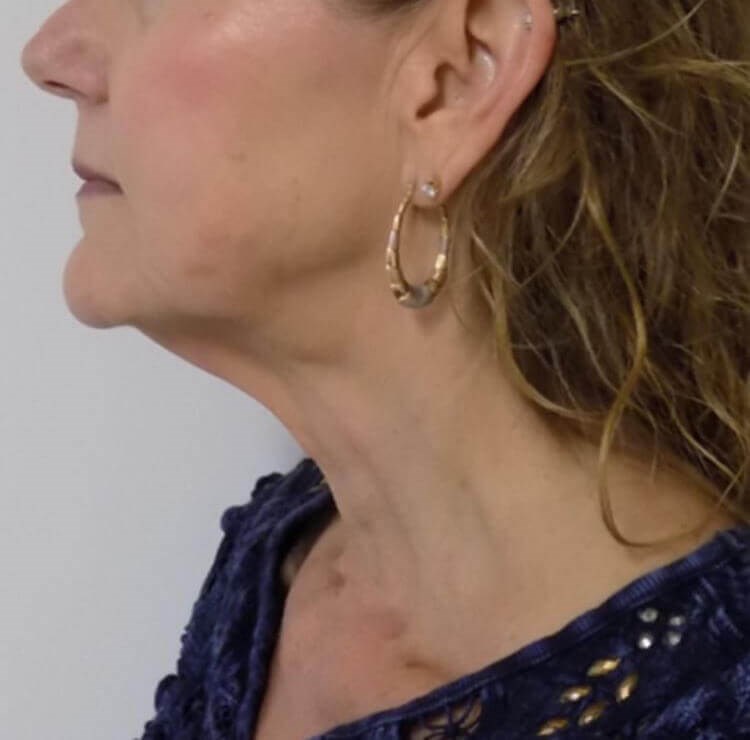 Alpine Neck Lift Before Alpine Neck Lift Before