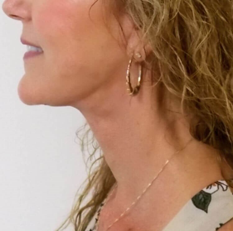 Alpine Neck Lift After Alpine Neck Lift After