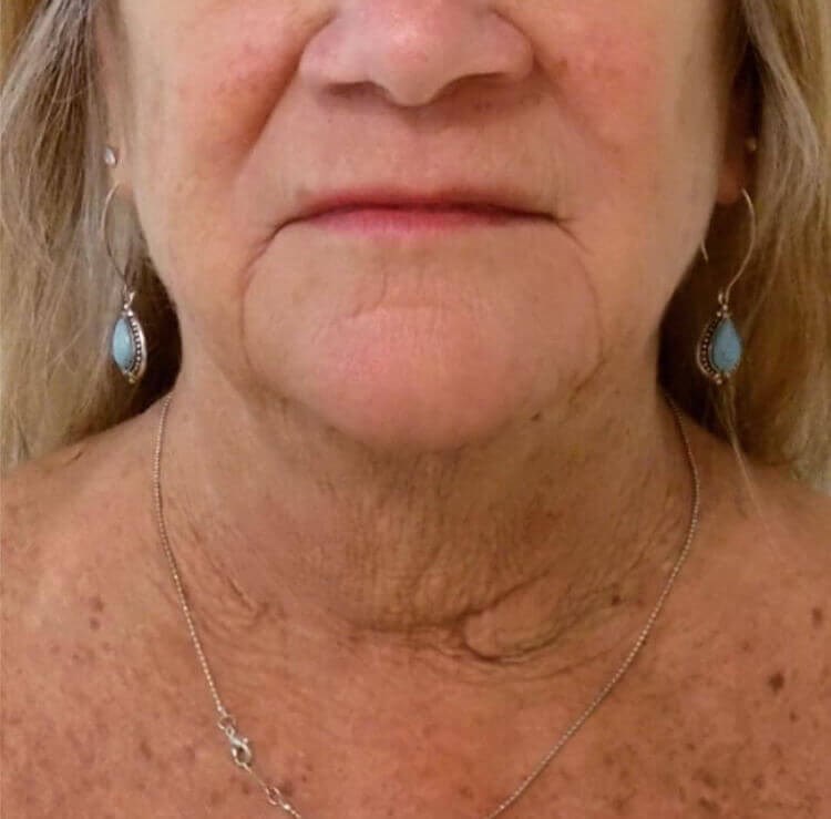 San Diego Neck Lift Before San Diego Neck Lift Before