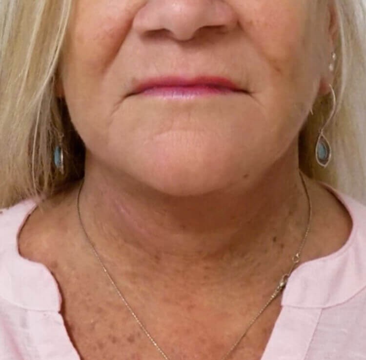 San Diego Neck Lift After San Diego Neck Lift After