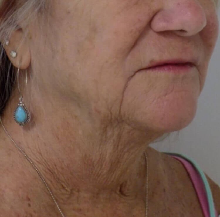San Diego Neck Lift Before San Diego Neck Lift Before