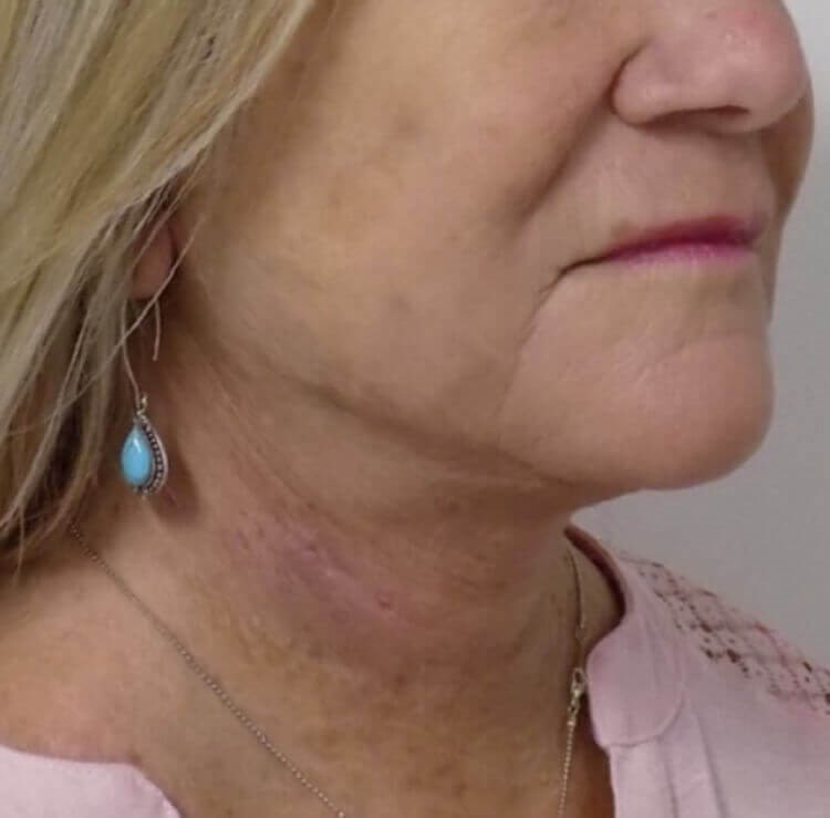 San Diego Neck Lift After San Diego Neck Lift After