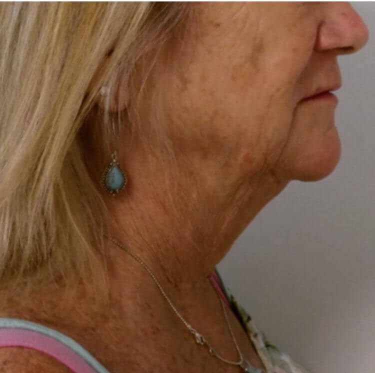 San Diego Neck Lift Before San Diego Neck Lift Before