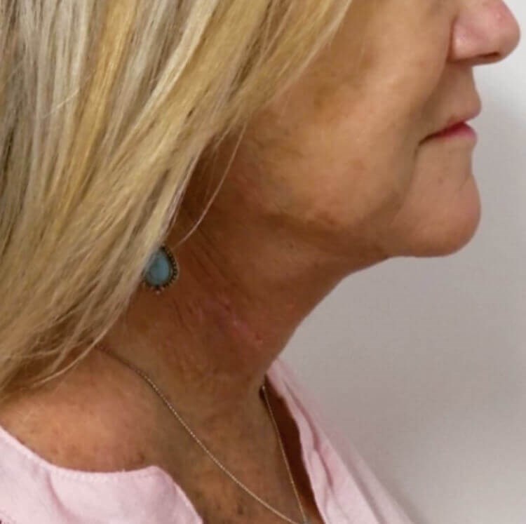 San Diego Neck Lift After San Diego Neck Lift After