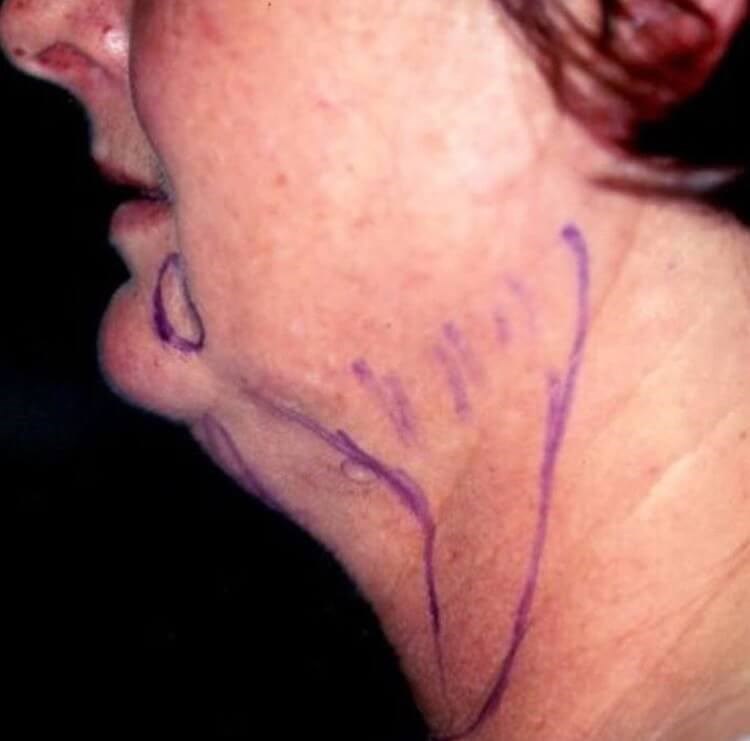 San Diego Neck Liposuction Before San Diego Neck Liposuction Before