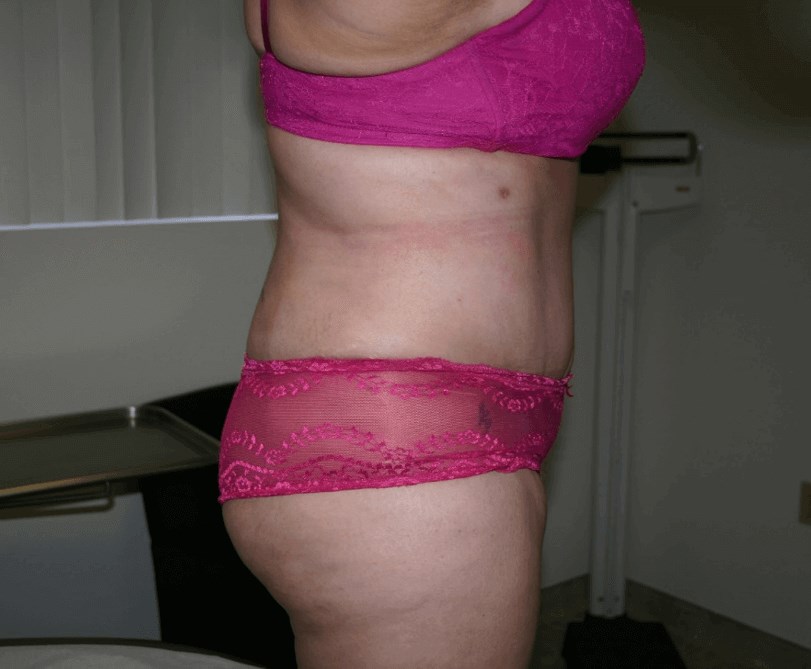 Mission Valley Tummy Tuck After Mission Valley Tummy Tuck After