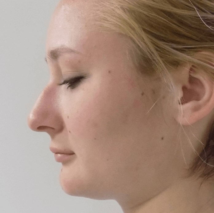 La Mesa Rhinoplasty Before La Mesa Rhinoplasty Before