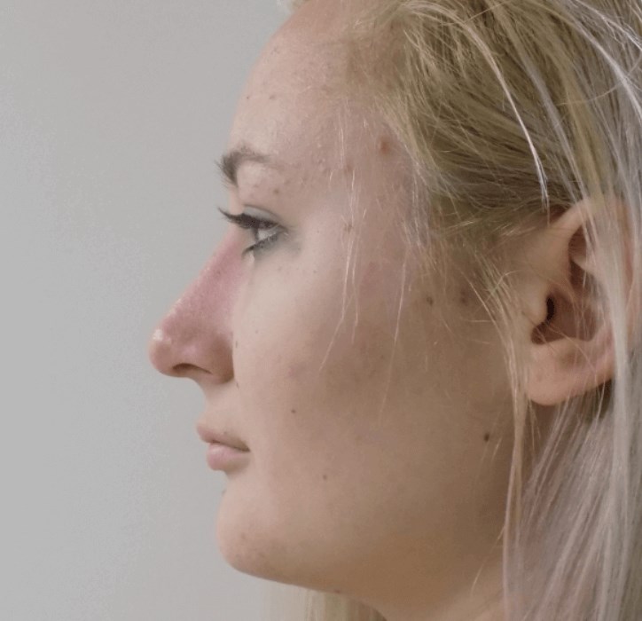 La Mesa Rhinoplasty After La Mesa Rhinoplasty After
