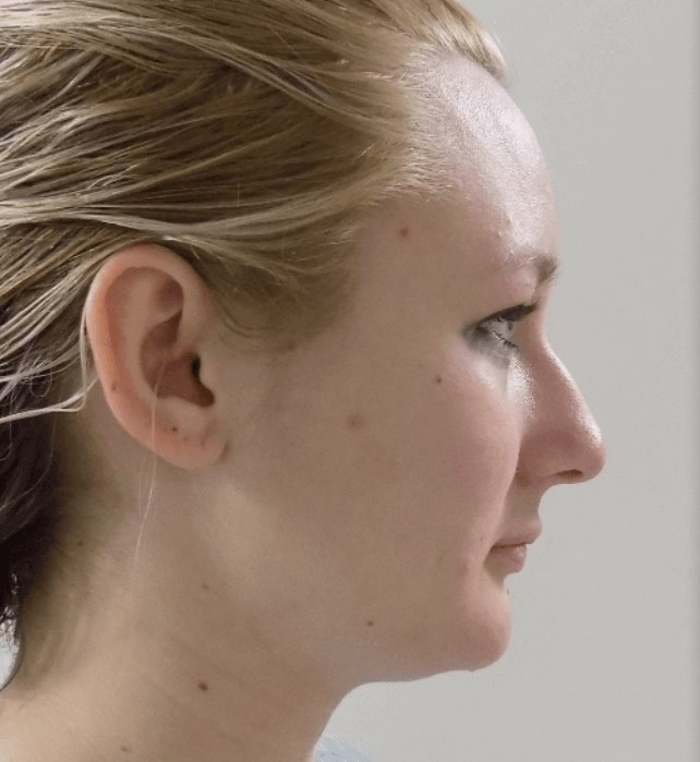 La Mesa Rhinoplasty Before La Mesa Rhinoplasty Before