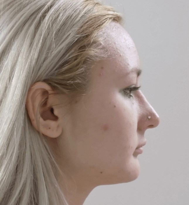 La Mesa Rhinoplasty After La Mesa Rhinoplasty After