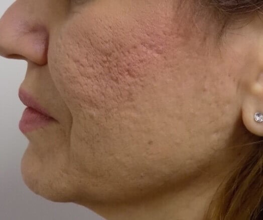 San Diego Scar Laser Treatment Before San Diego Scar Laser Treatment Before