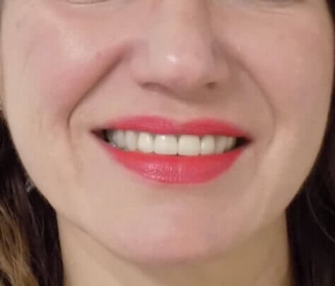 San Diego Scar Laser Treatment After San Diego Scar Laser Treatment After