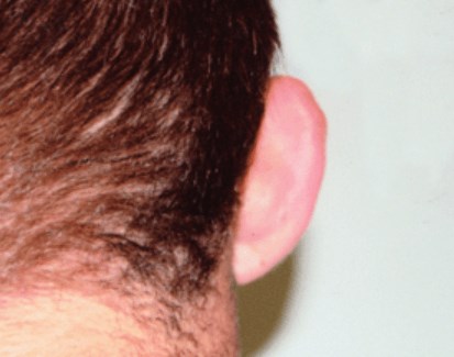 San Diego Otoplasty Before San Diego Otoplasty Before