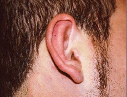 San Diego Otoplasty After San Diego Otoplasty After