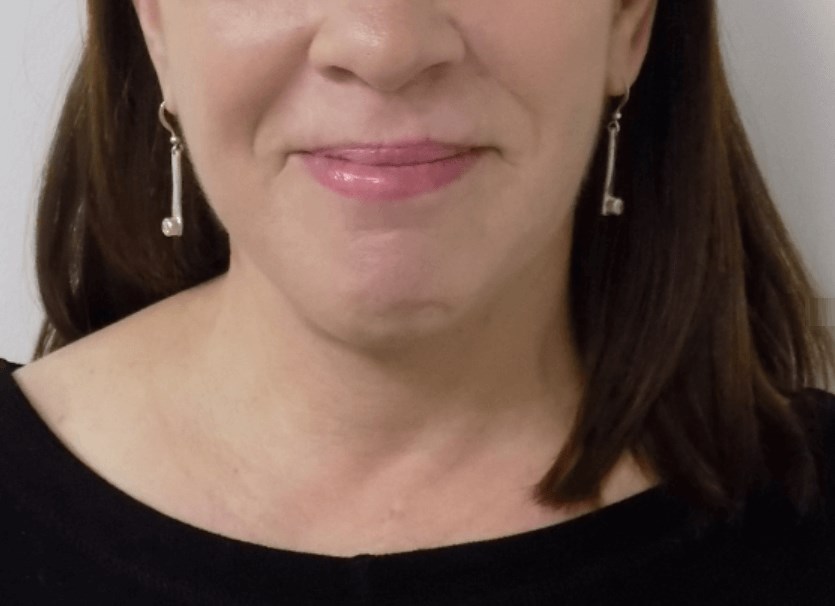 La Mesa Face & Neck Surgery After La Mesa Face & Neck Surgery After