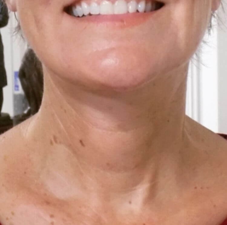 San Diego Neck Lift Surgery After