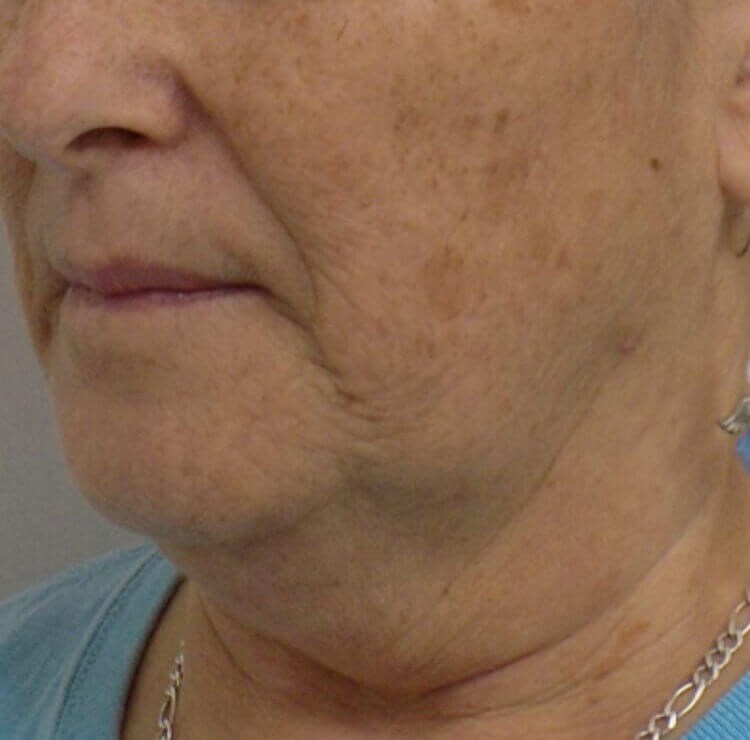 San Diego Neck Lift & Laser Before