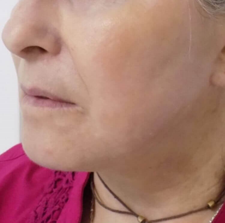 San Diego Neck Lift & Laser After