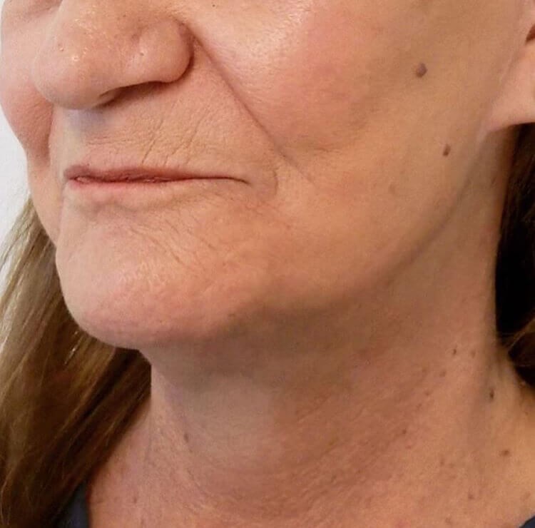 San Diego Facelift After