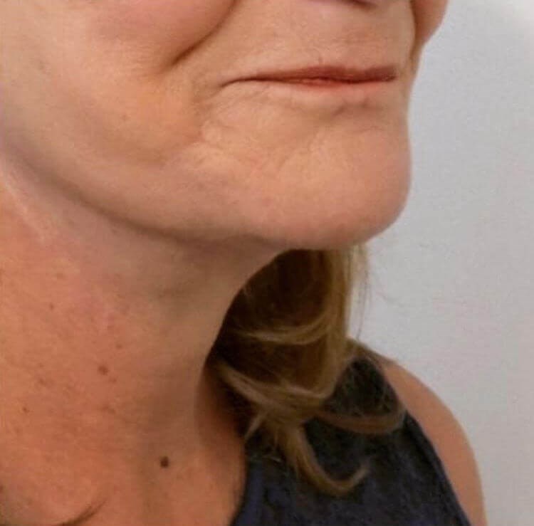 San Diego Facelift After