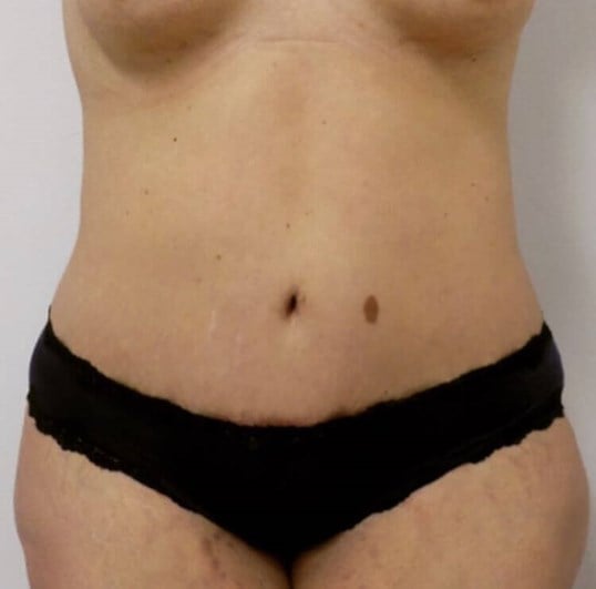 Tummy Tuck in San Diego - Abdominoplasty