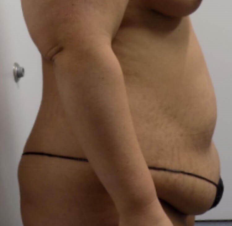 Side View of Tummy Tuck Before