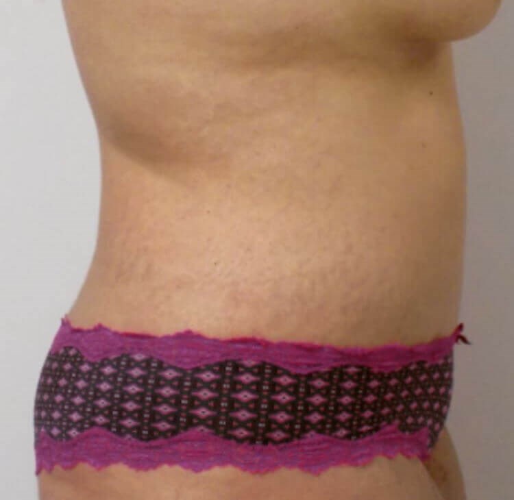 Side View of Tummy Tuck After