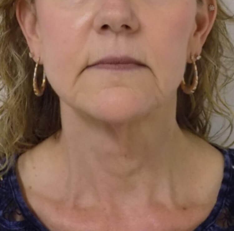 Alpine Neck Lift Before
