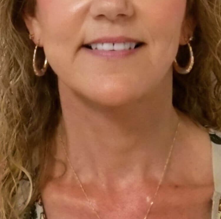 Alpine Neck Lift After