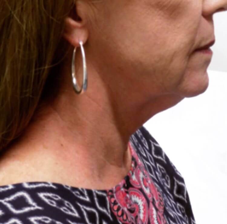 San Diego Natural Facelift Before