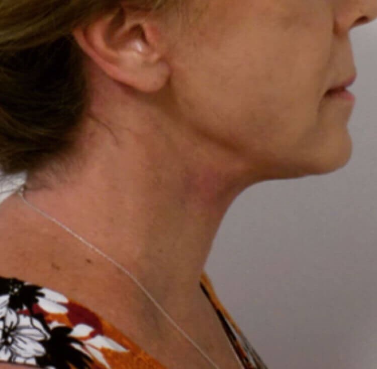 San Diego Natural Facelift After