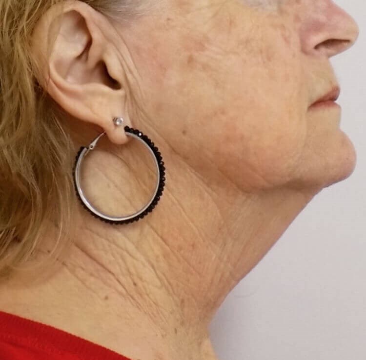 El Cajon Face and Neck Lift Before