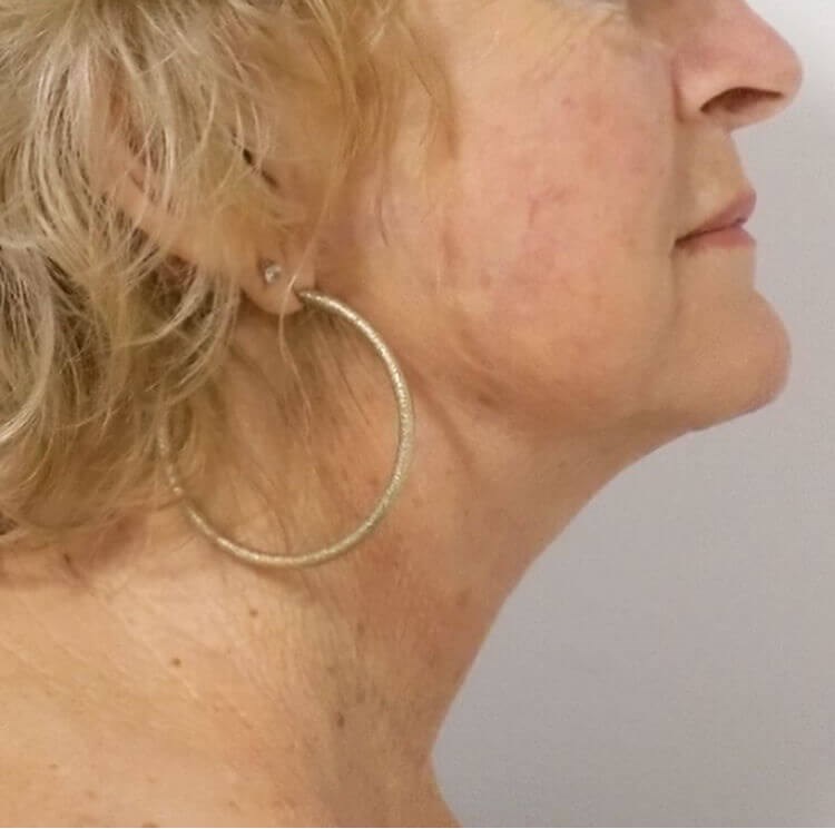 El Cajon Face and Neck Lift After