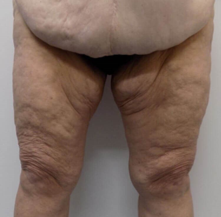 El Cajon Thigh Lift Before