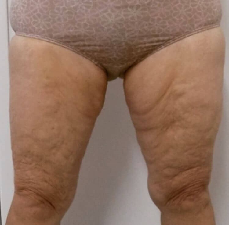 El Cajon Thigh Lift After