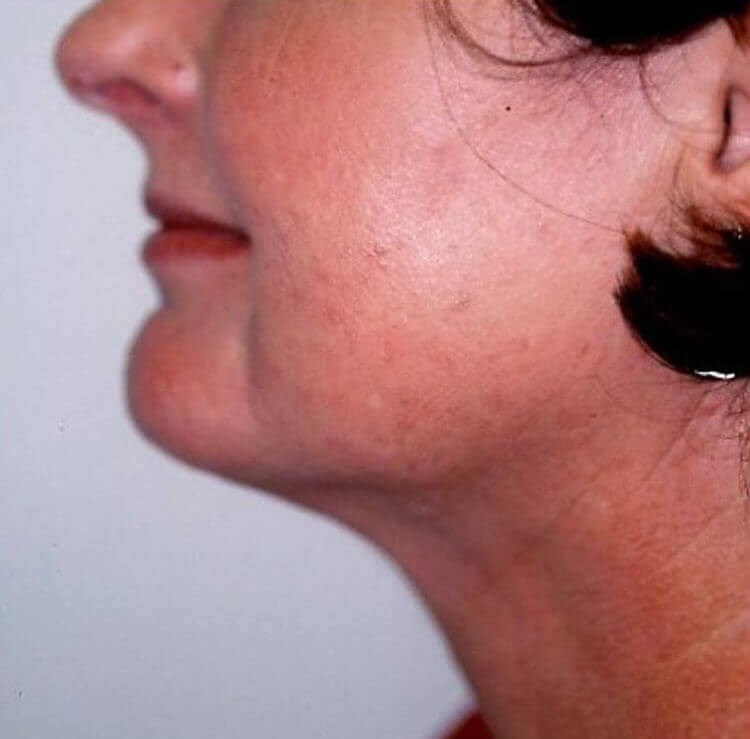 San Diego Neck Liposuction After