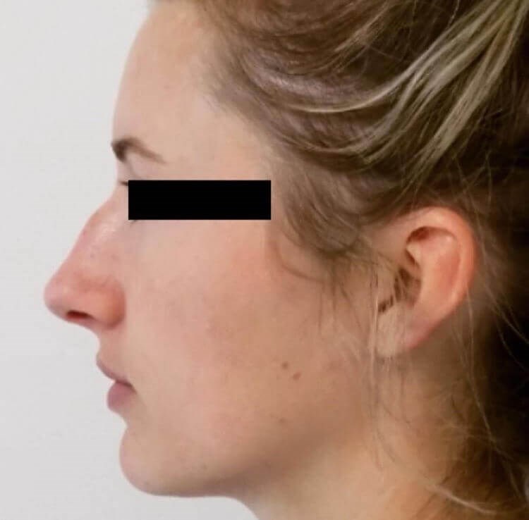 San Diego Rhinoplasty Before