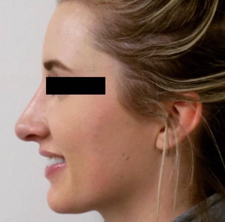 San Diego Rhinoplasty After
