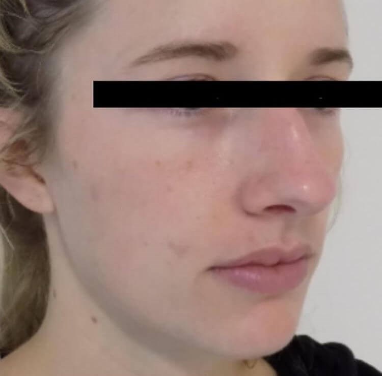 San Diego Rhinoplasty Before