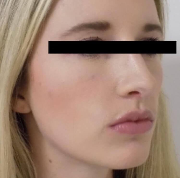San Diego Rhinoplasty After