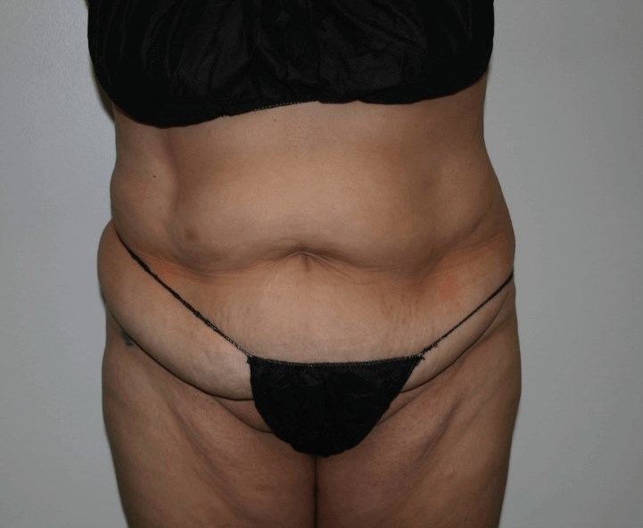Mission Valley Tummy Tuck Before