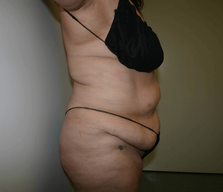 Mission Valley Tummy Tuck Before