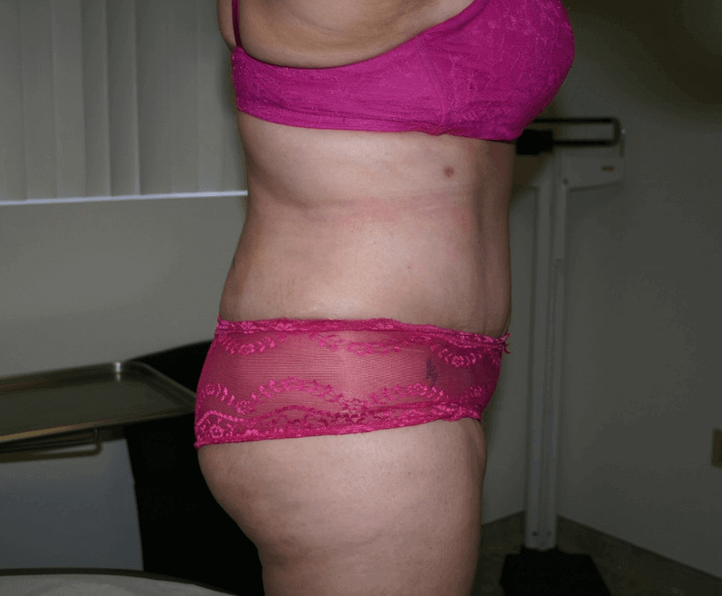 Mission Valley Tummy Tuck After