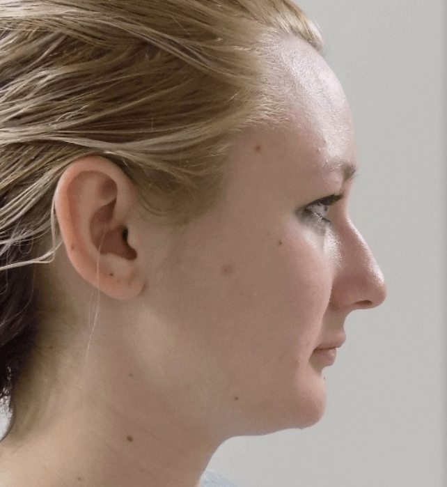 La Mesa Rhinoplasty Before