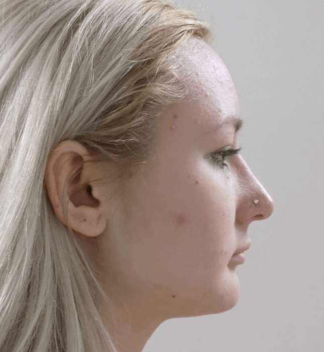 La Mesa Rhinoplasty After