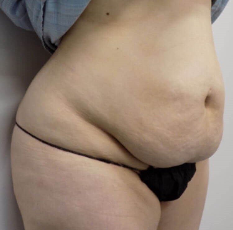 San Diego  Abdominoplasty Before