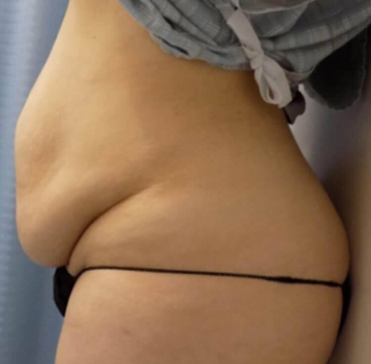 San Diego Abdominoplasty Before