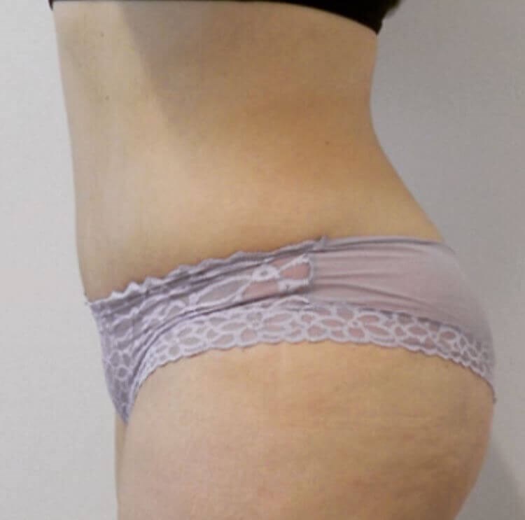 San Diego Abdominoplasty After