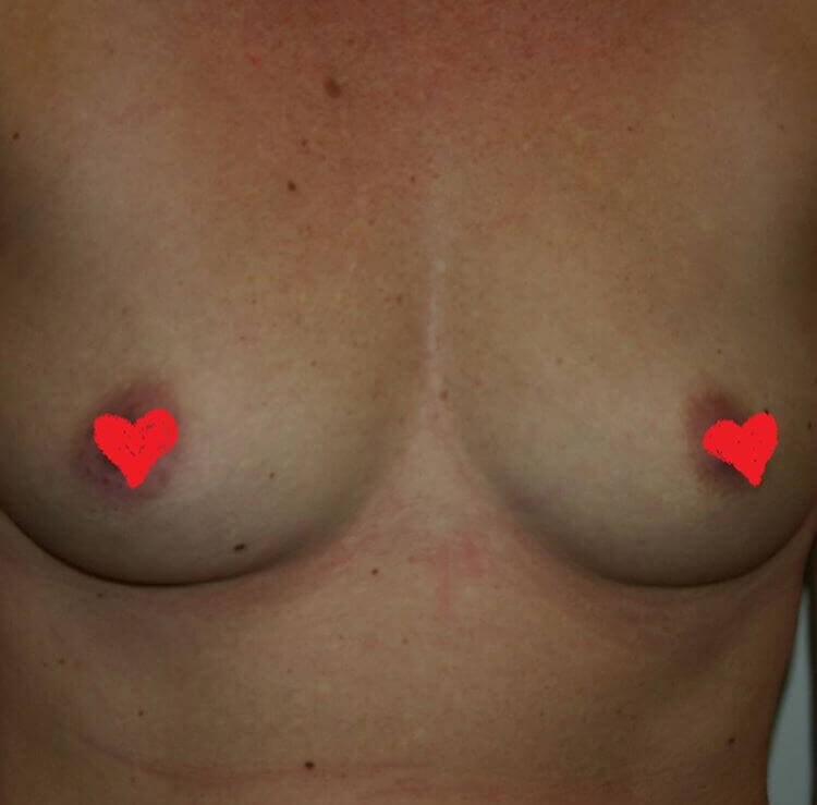 San Diego Breast Augmentation Before